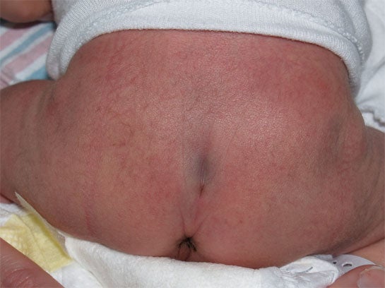 sacral dimple1.jpg